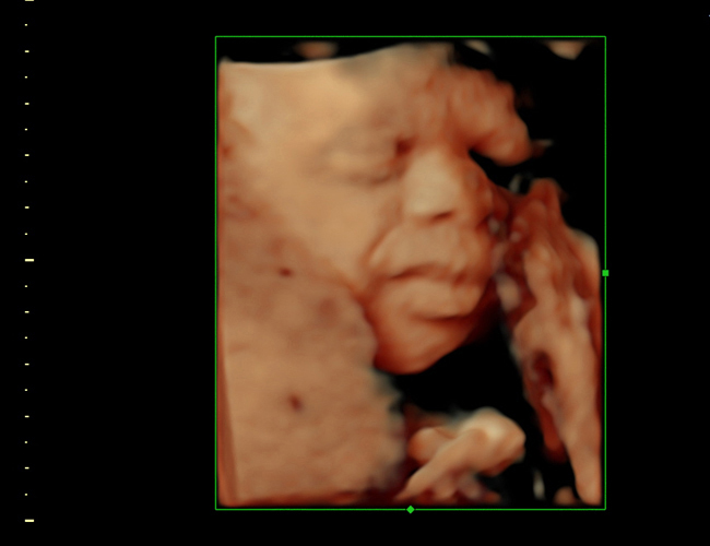 3D ultrasound image at 28 weeks